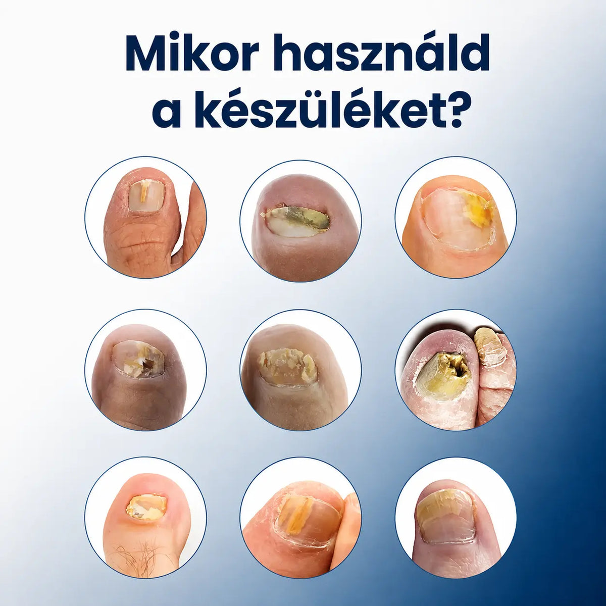 LightCare Pro™ körömgomba kezelő készülék