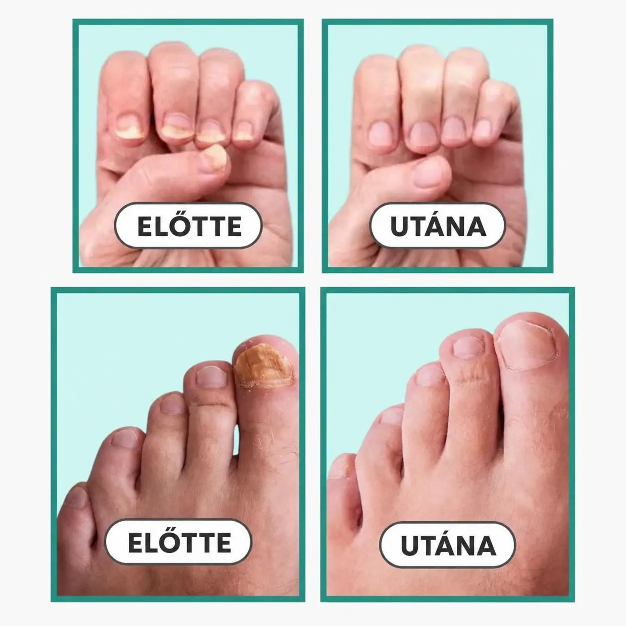 LightCare Pro™ körömgomba eltávolító