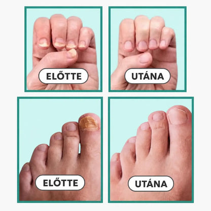 LightCare Pro™ körömgomba eltávolító